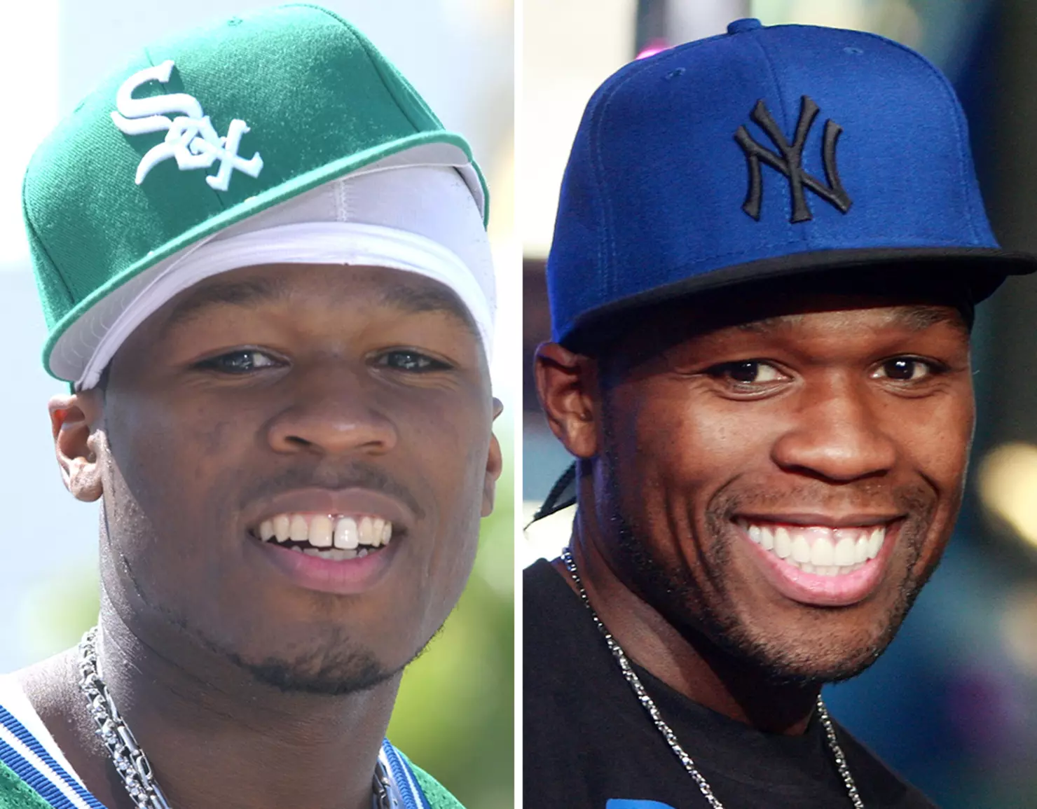 hitman holla teeth before after