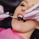 Cost of Dental Bonding