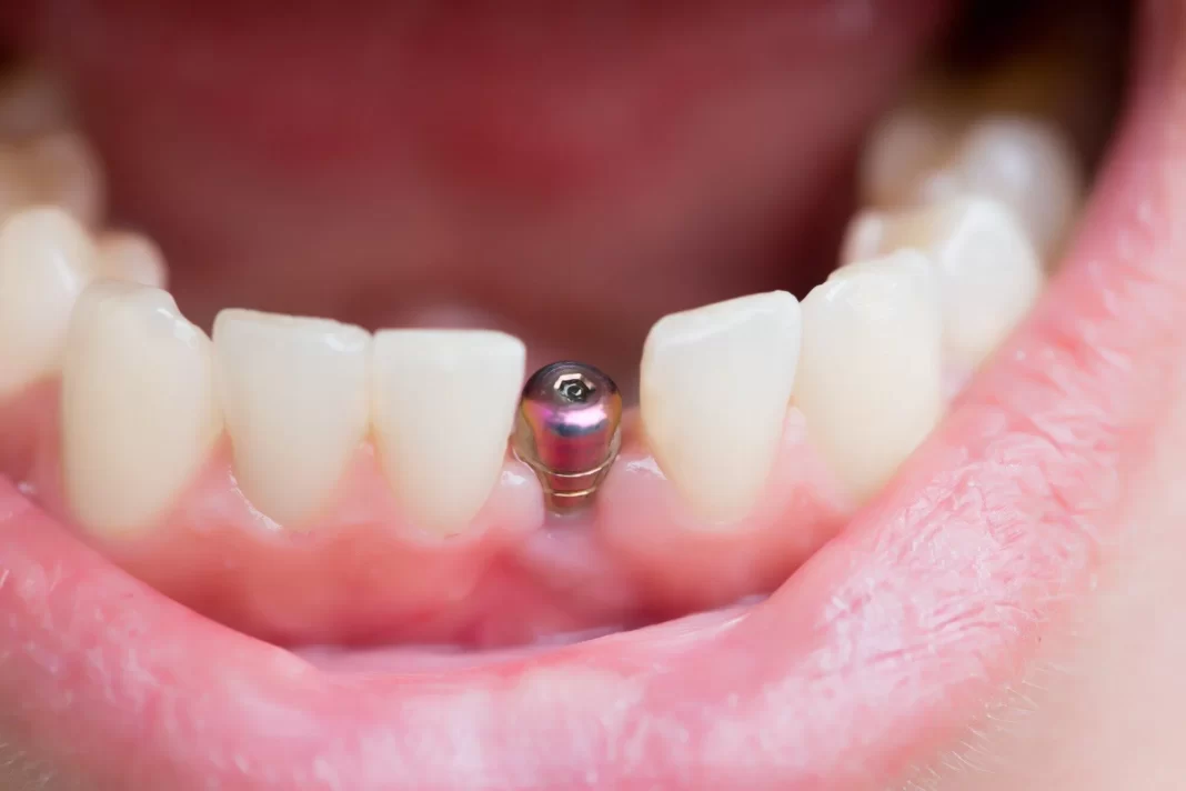 Tooth Implant